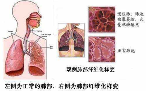 广西确诊新型肺炎病例/广西确诊新冠