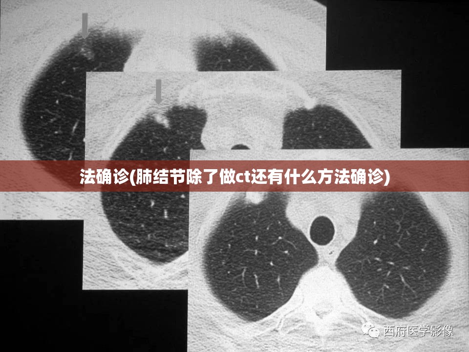 法确诊(肺结节除了做ct还有什么方法确诊)