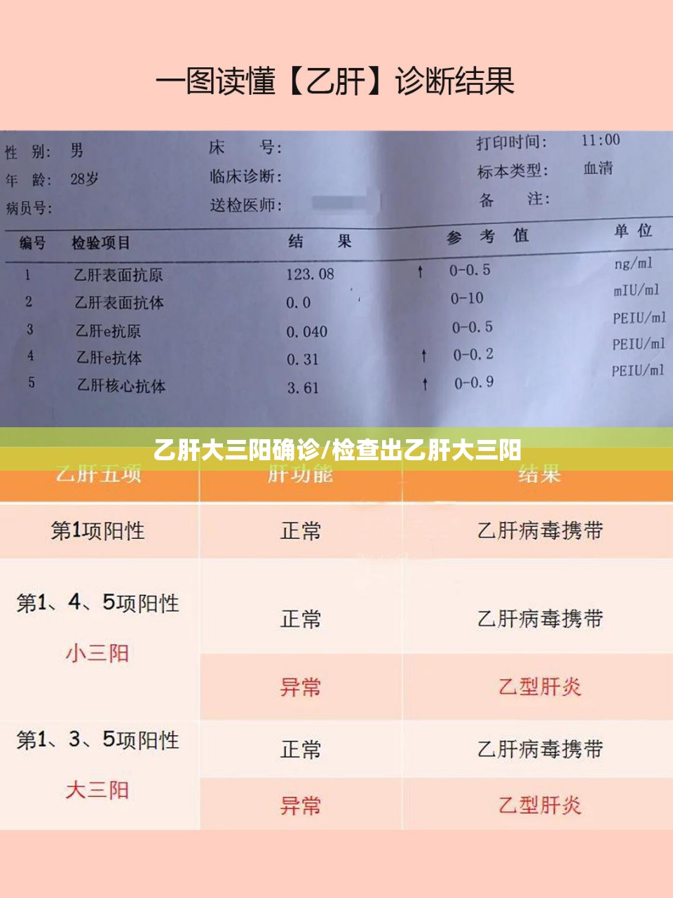 乙肝大三阳确诊/检查出乙肝大三阳