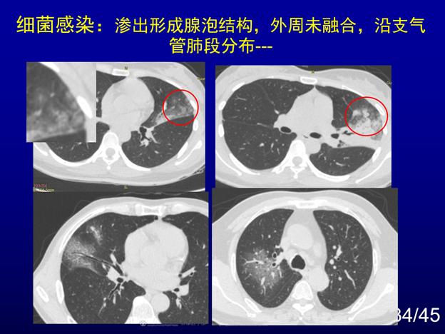 新冠肺炎确诊和出院(新冠肺炎确诊出院标准)