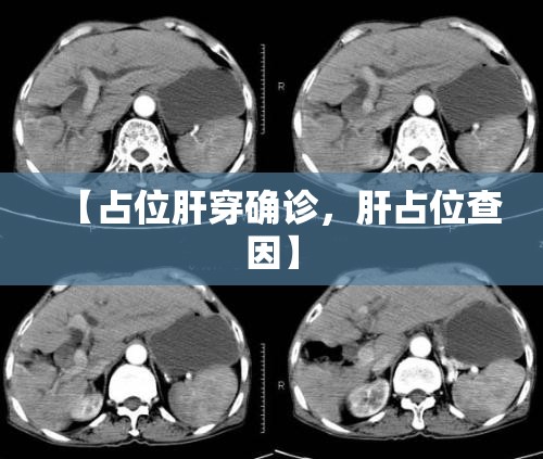 【占位肝穿确诊，肝占位查因】