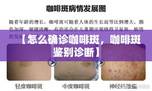【怎么确诊咖啡斑，咖啡斑鉴别诊断】
