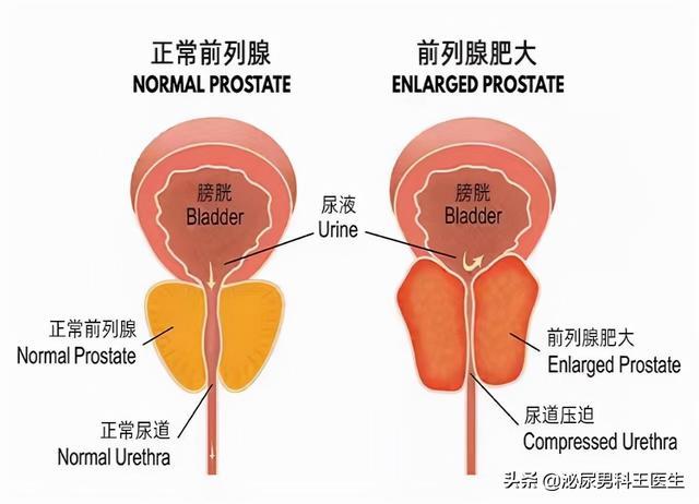 前列腺如何确诊(前列腺确诊方法)