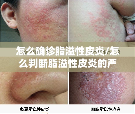 怎么确诊脂溢性皮炎/怎么判断脂溢性皮炎的严重程度