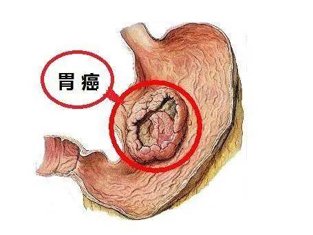 胃癌最早确诊/胃癌一般发现是早期还是晚期