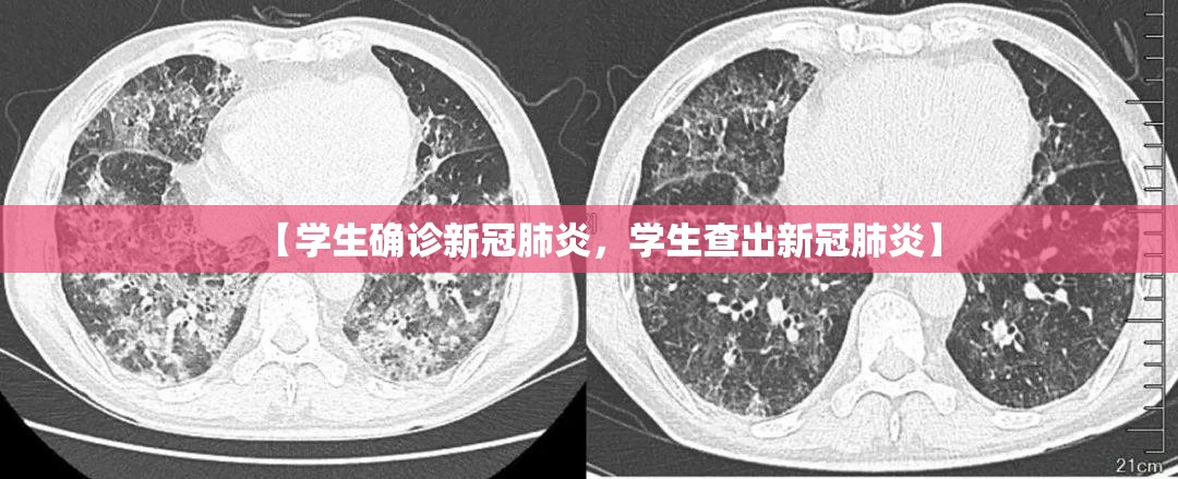 【学生确诊新冠肺炎，学生查出新冠肺炎】